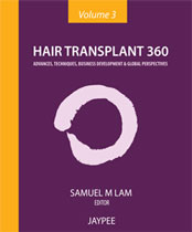 hair transplant 360
