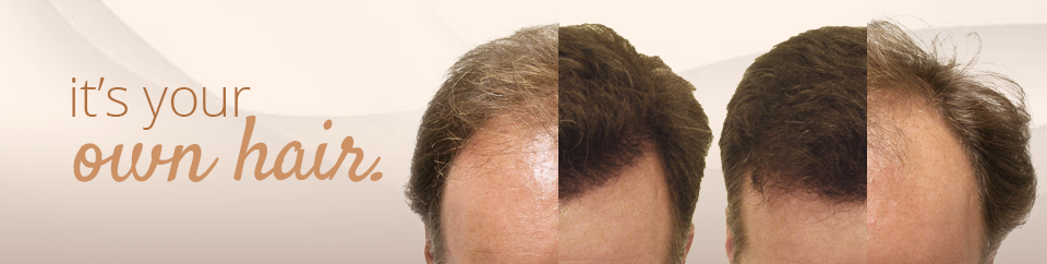 Cincinnati Laser Hair Removal & Hair Transplants | Wolf Medical