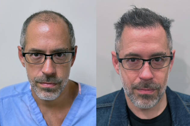 Side-by-side comparison of a man before and after hair restoration by Cincinnati hair restoration specialists; left image shows thinning hair, right image shows fuller hair.