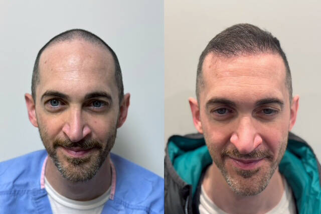 Side-by-side photos show a man before and after his Wolf Hair Restoration procedure; left image displays a receding hairline, while the right reveals fuller hair growth by leading Cincinnati hair restoration specialists.