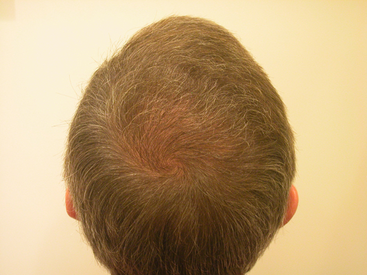 The back of a person's head showing thinning brown hair and a visible cowlick against a plain light background.