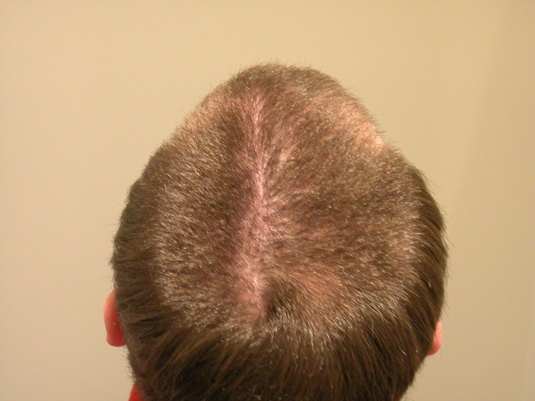 The top of a person's head is shown from behind, displaying thinning hair and a visible scalp.