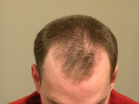 A man with short brown hair showing thinning and mild balding on the top and front of his scalp, looking downward.