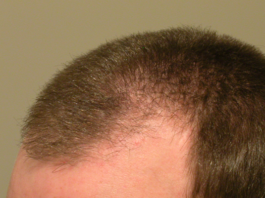 Close-up of the top of a person's head showing thinning hair and partial baldness on the front scalp against a plain background.