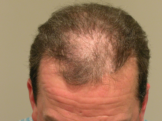 A man with thinning hair on the top of his head, showing signs of male pattern baldness.