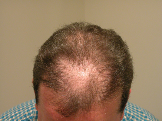 A man with thinning hair and a receding hairline is looking down, revealing significant baldness on the top of his head.