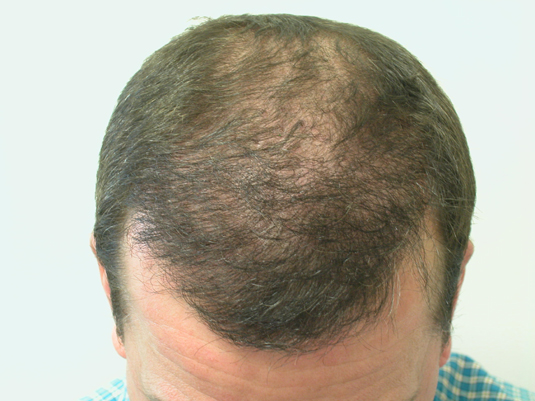 Top view of a man's head showing thinning hair and noticeable scalp, indicating male pattern baldness.