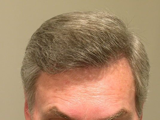 A close-up of the top part of a person's head with neatly combed gray hair and a visible forehead.