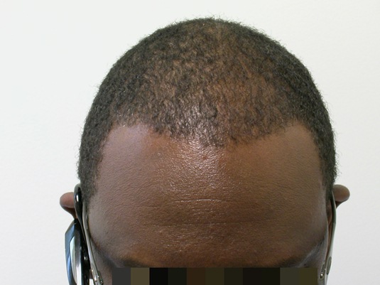 A close-up view of the top of a person's head showing thinning hair and a receding hairline.