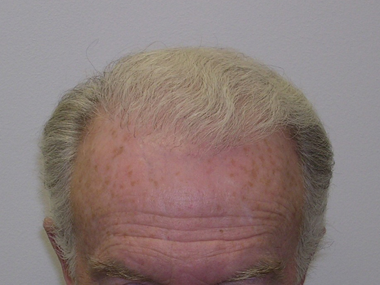 A close-up of the upper forehead and hairline of an older man with thinning, gray hair and visible age spots on the skin.