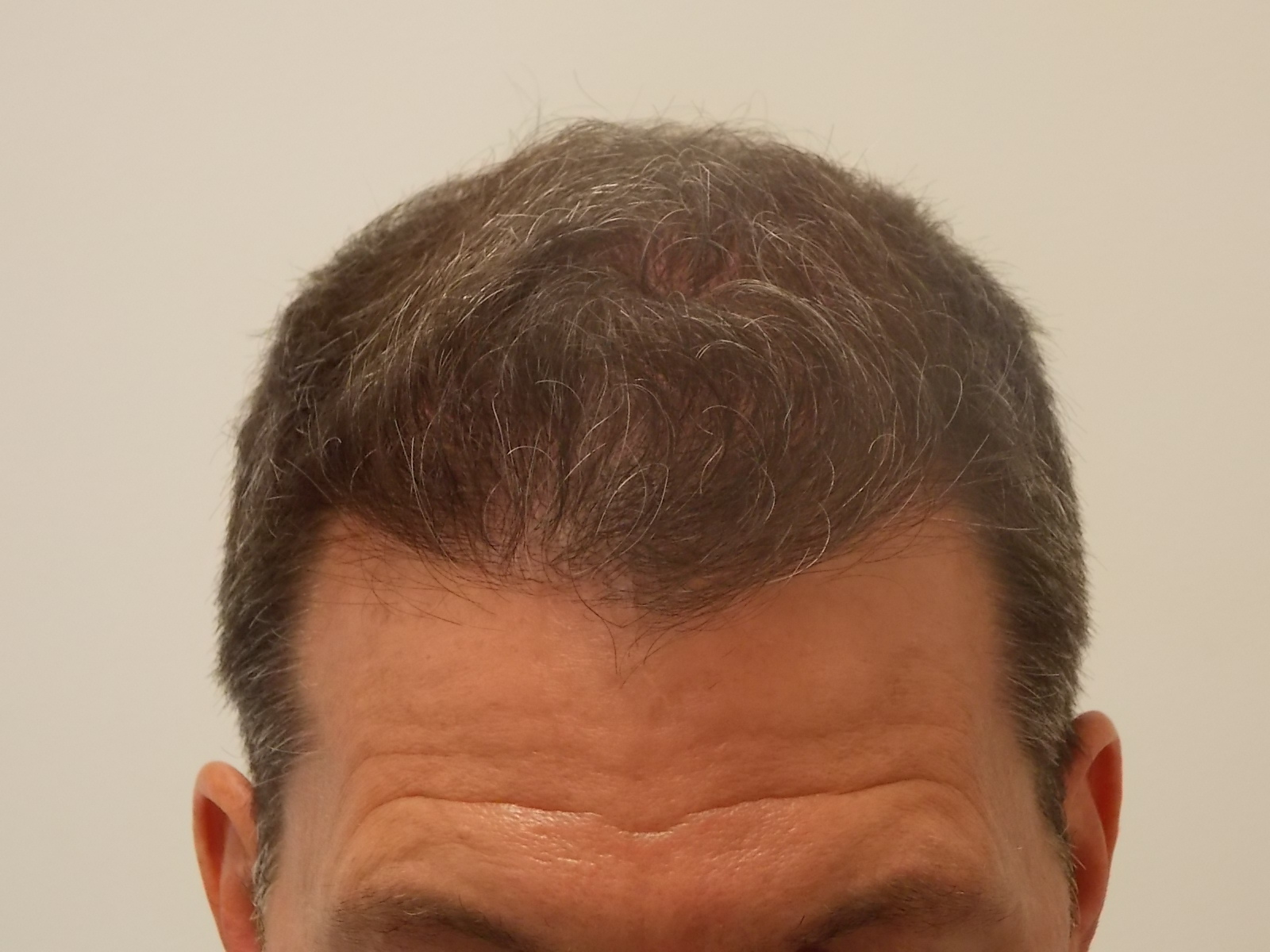 Close-up of the top of a man's head showing thinning, graying hair and a slightly receding hairline against a plain background.