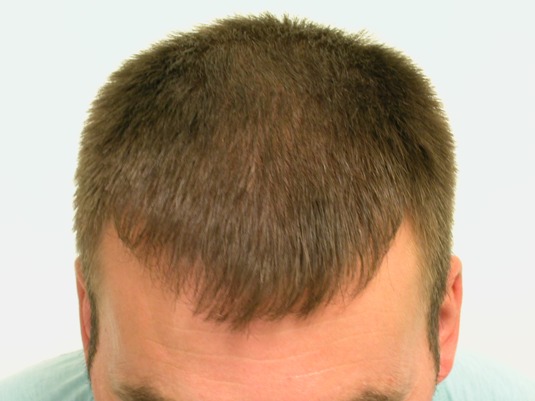 Top view of a man's head with short brown hair, showing thinning hair near the crown.