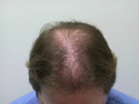 Prior to treatment, old grafts are sparse and unnatural