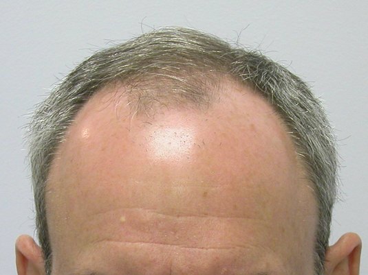 Prior to treatment