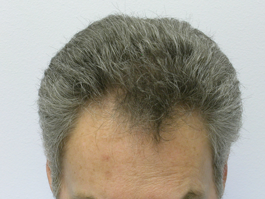 Prior to treatment