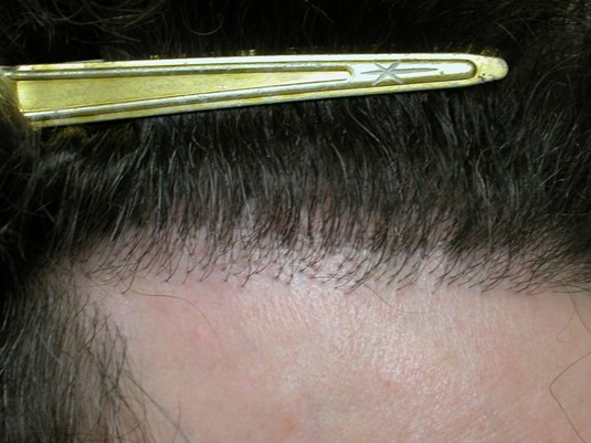 Hairline 5 years post-op.