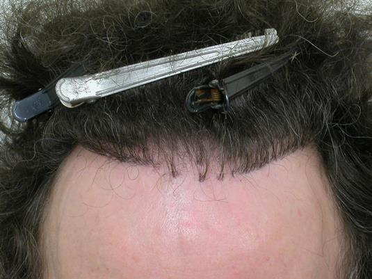 Hairline before surgery.