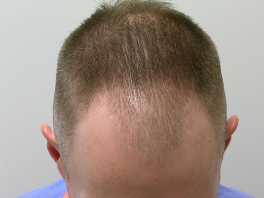 Top view of head- hair cut short (shaven) for FUE procedure.