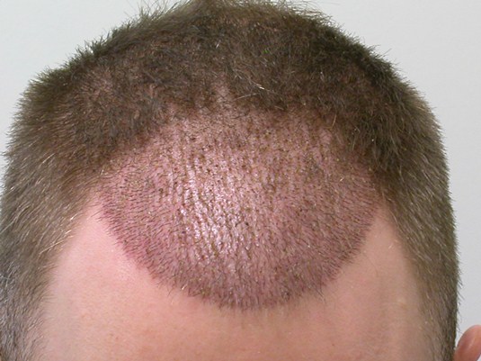 Hairline 10 days post-op.