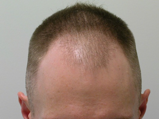 Hairline before surgery- hair cut short (shaven) for FUE procedure.