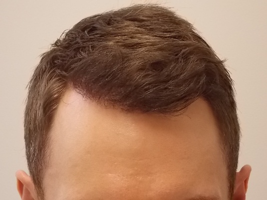 Hairline 6 months post-op.