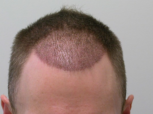 Hairline 10 days post-op.