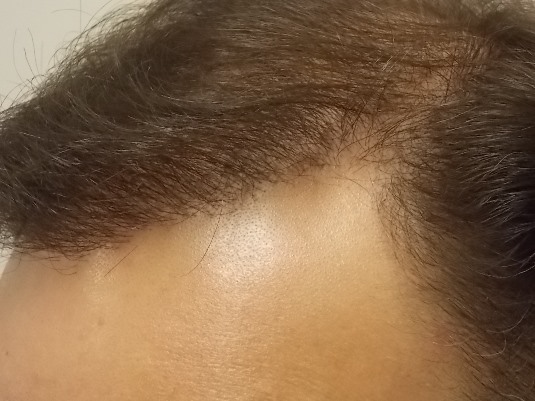Left side hairline after surgery.