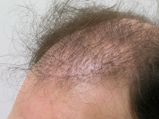 Left side hairline before surgery.