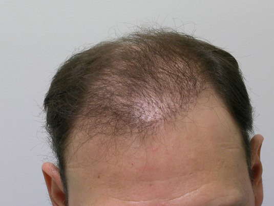 Hairline before surgery.