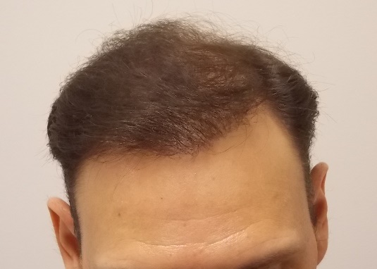 Hairline after surgery.