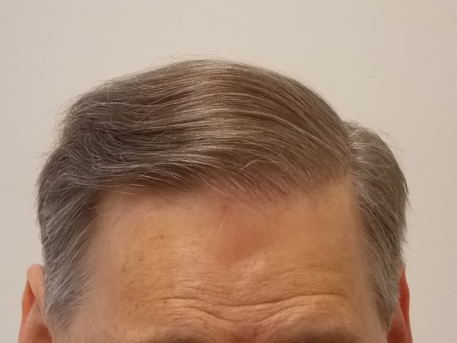 1.5 years post op.