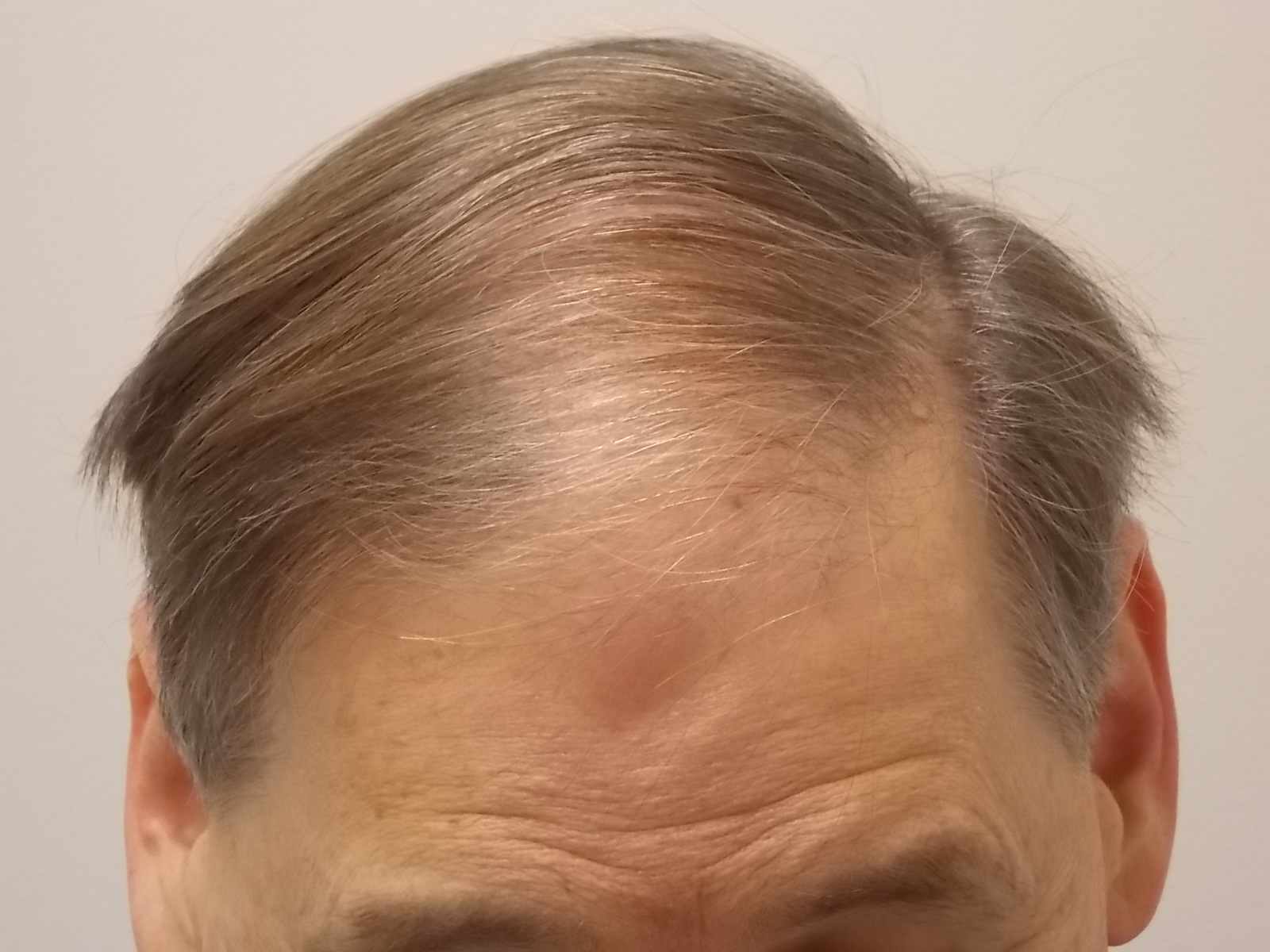 Before surgery; Close up- comb over style