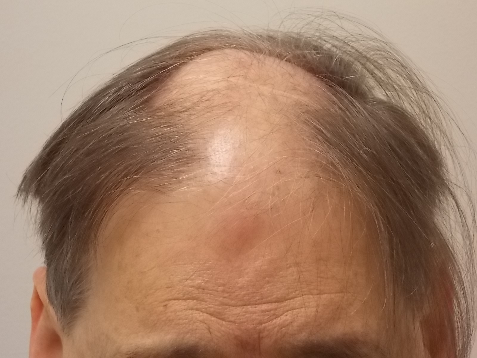 Before surgery; Balding area exposed under comb over