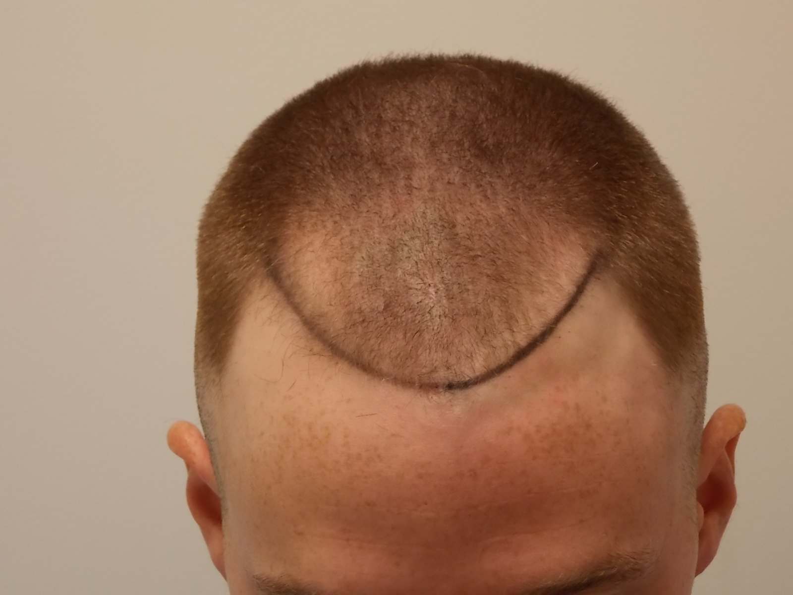 Head shaved before surgery- hairline drawn