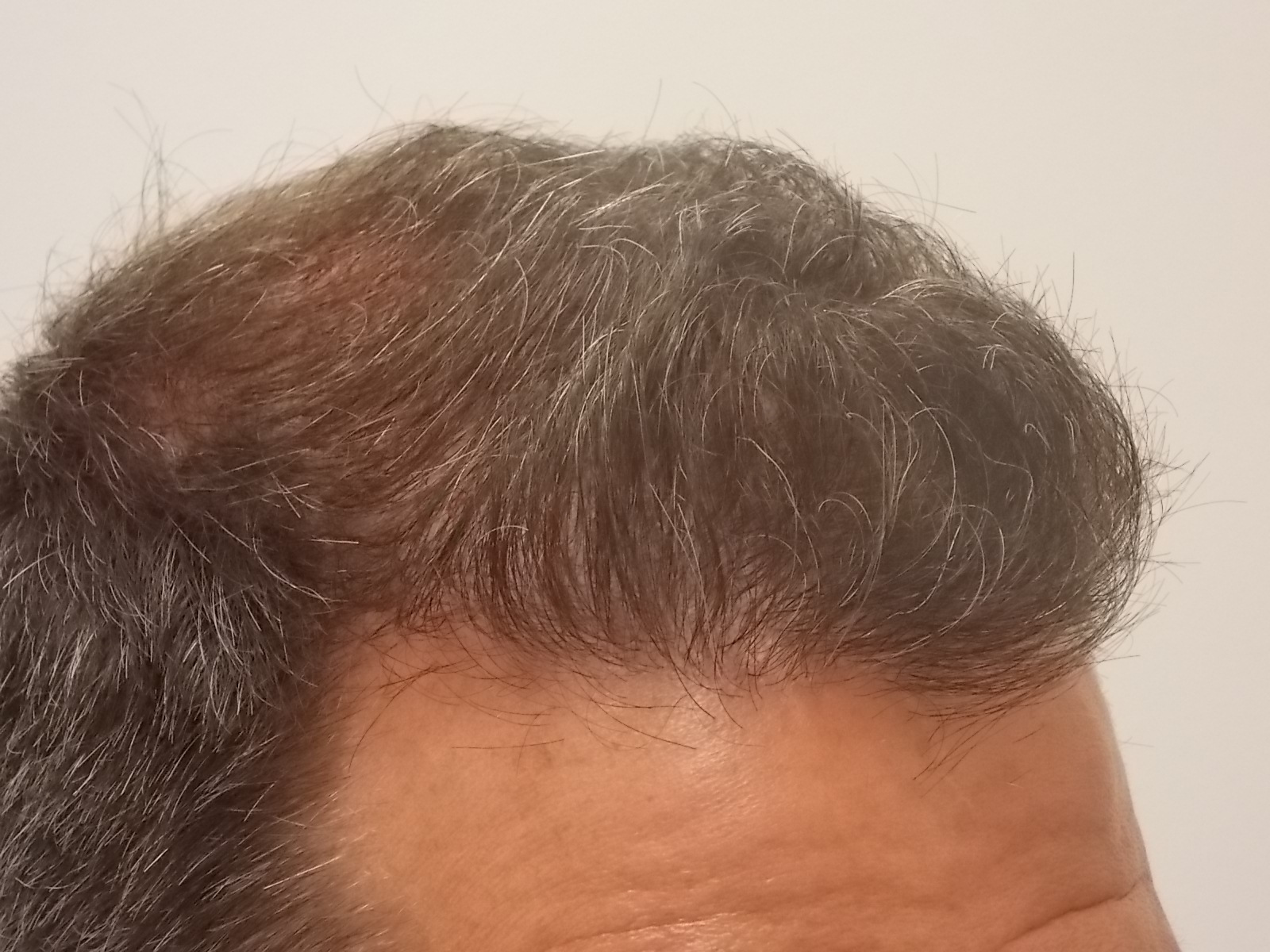 1.5 years post-op