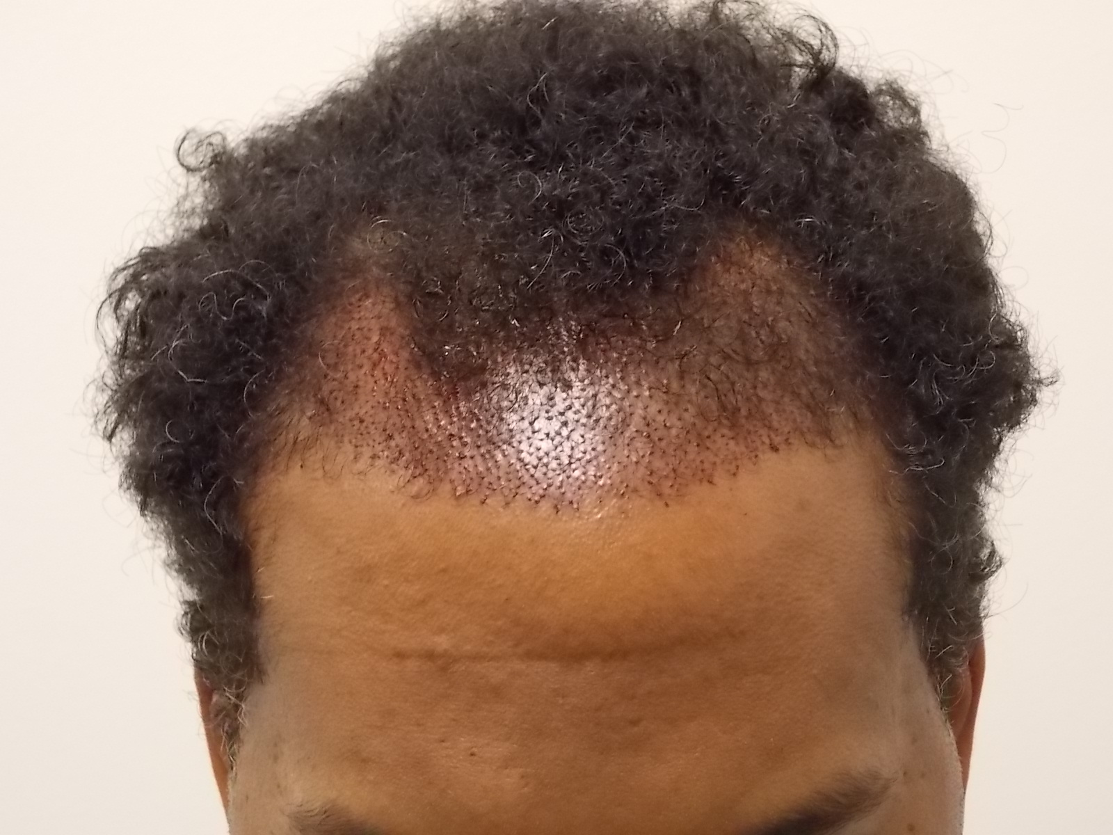 Forehead immediately post-op