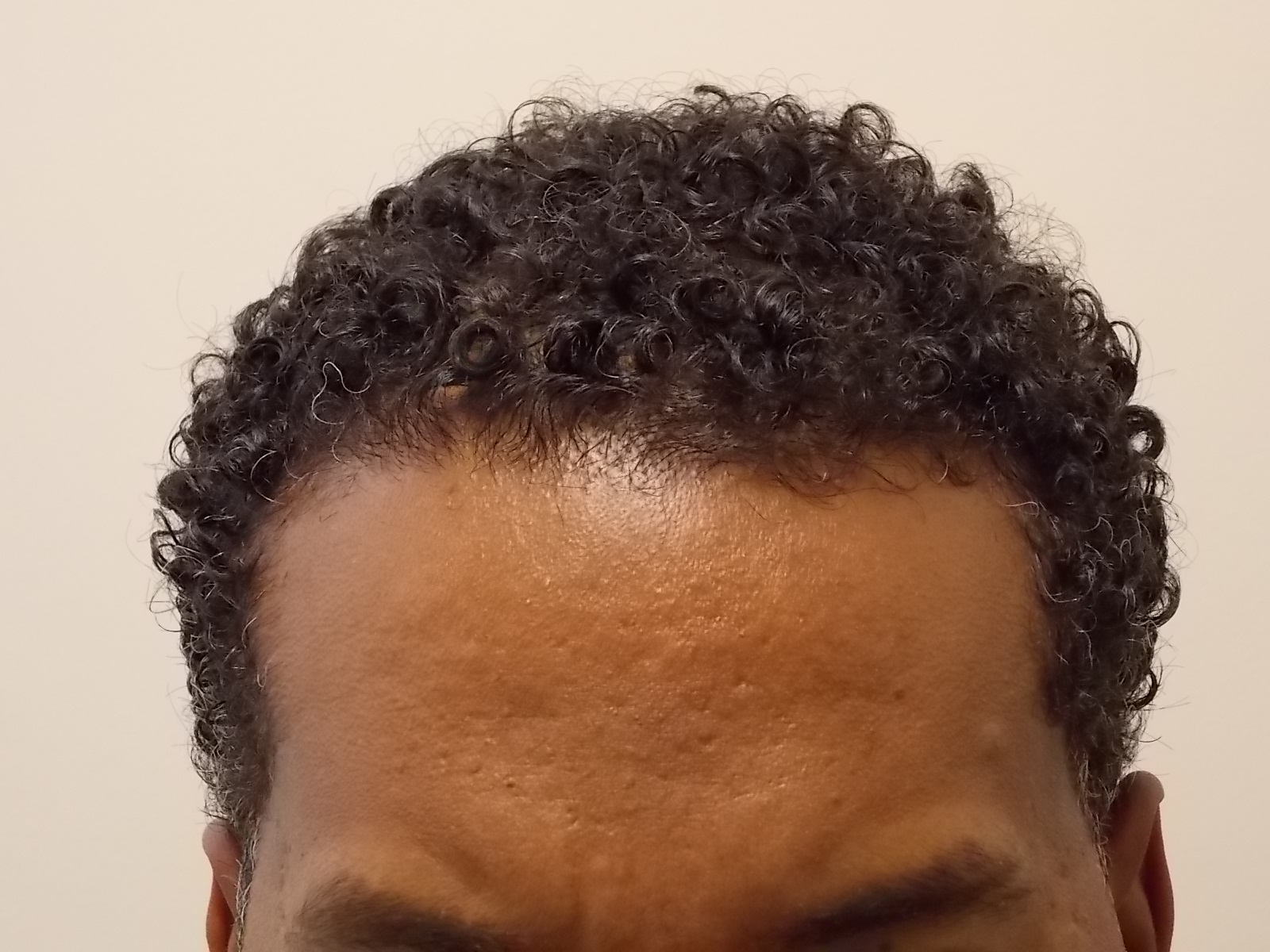 Forehead ten months post-op