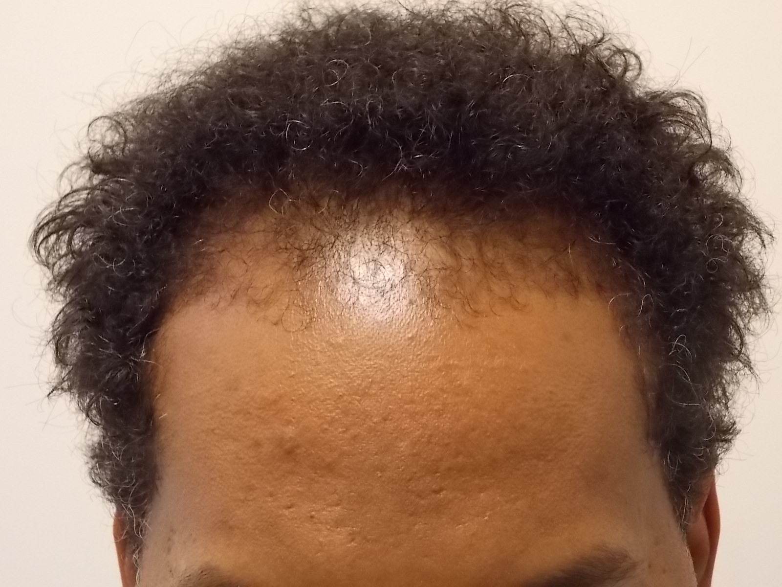 Forehead before surgery