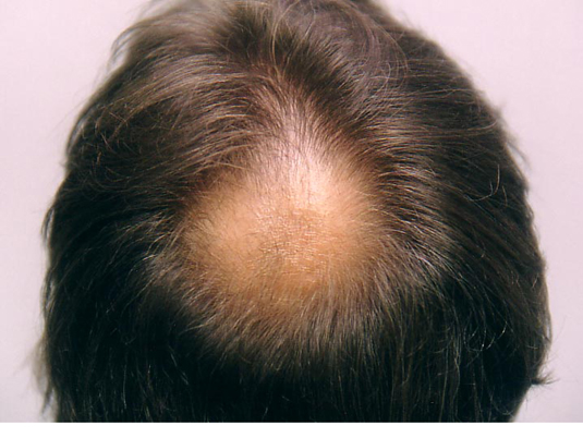 Prior to treatment